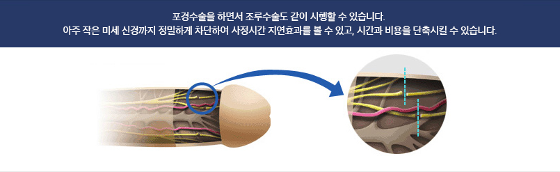 포경수술+조루 수술 설명