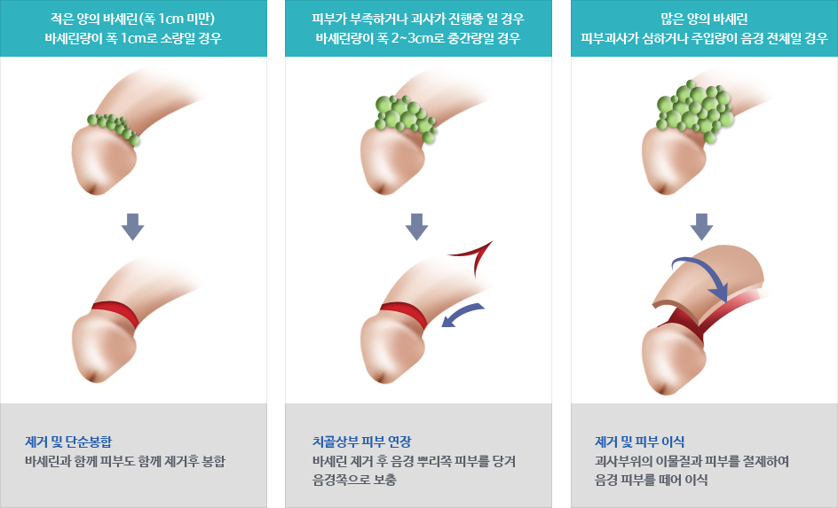 블루 바세린제거술