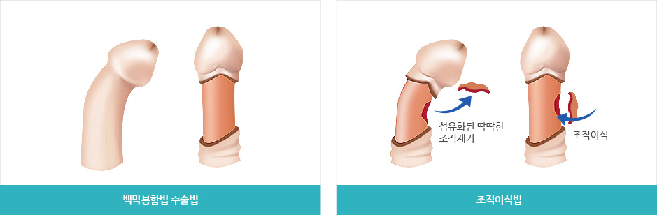 블루 음경만곡증 수술